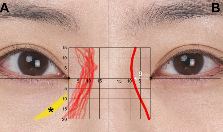 필러 이 부위 주사하면 실명 위험 커져